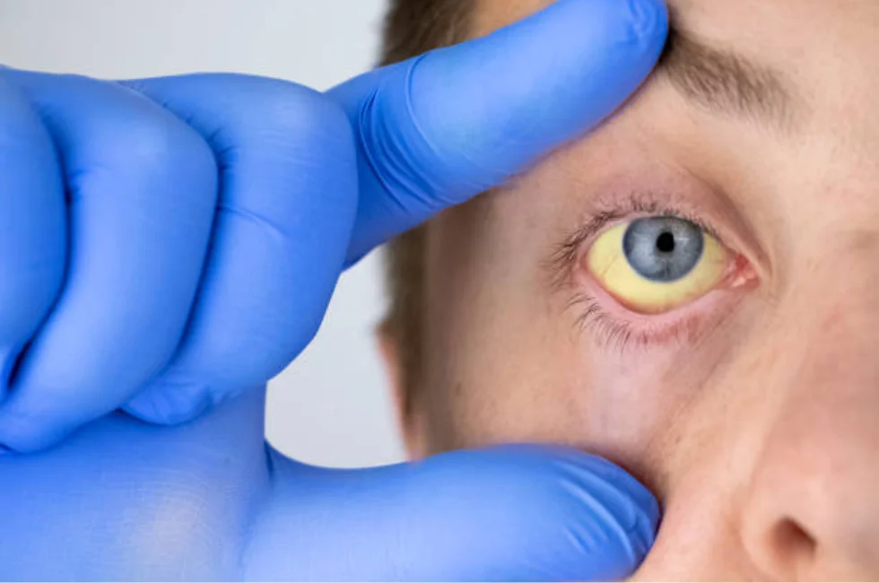 Leptospirose: O Inimigo Invisível que se Esconde nas Águas das Enchentes