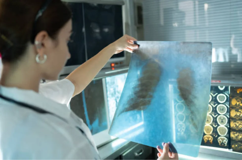 Tuberculose: A Antiga Inimiga que Ainda Desafia a Medicina Moderna